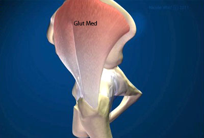 Gluteus Repair