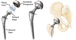 Total Hip Replacement (THR)